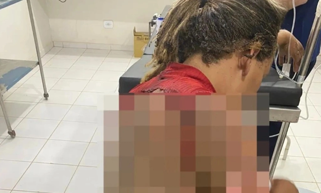 Homem é preso por atear fogo na companheira enquanto ela dormia