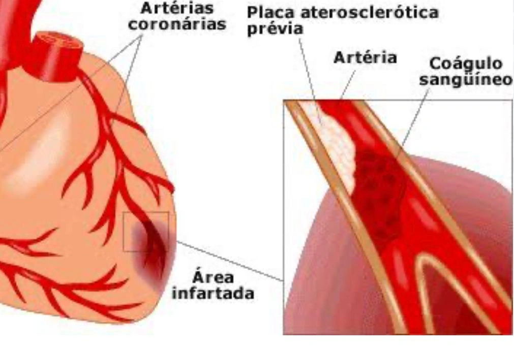 Artérias