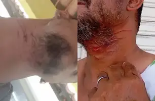 Arame farpado em estrada deixa motociclistas com ferimentos no pescoço em Pio IX (Foto: Reprodução)
