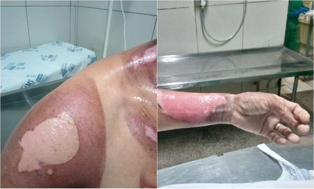 Vítima teve mais de 20% do corpo queimado