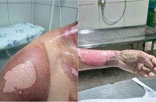 Vítima teve mais de 20% do corpo queimado (Foto: Reprodução)