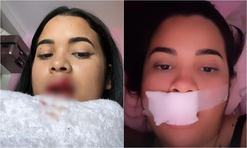 Eryka Costa teve boca mordida pelo próprio cachorro