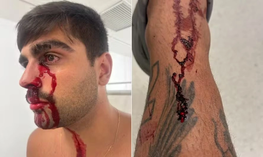 Gustavo terá de fazer um procedimento para recupera o canal lacrimal