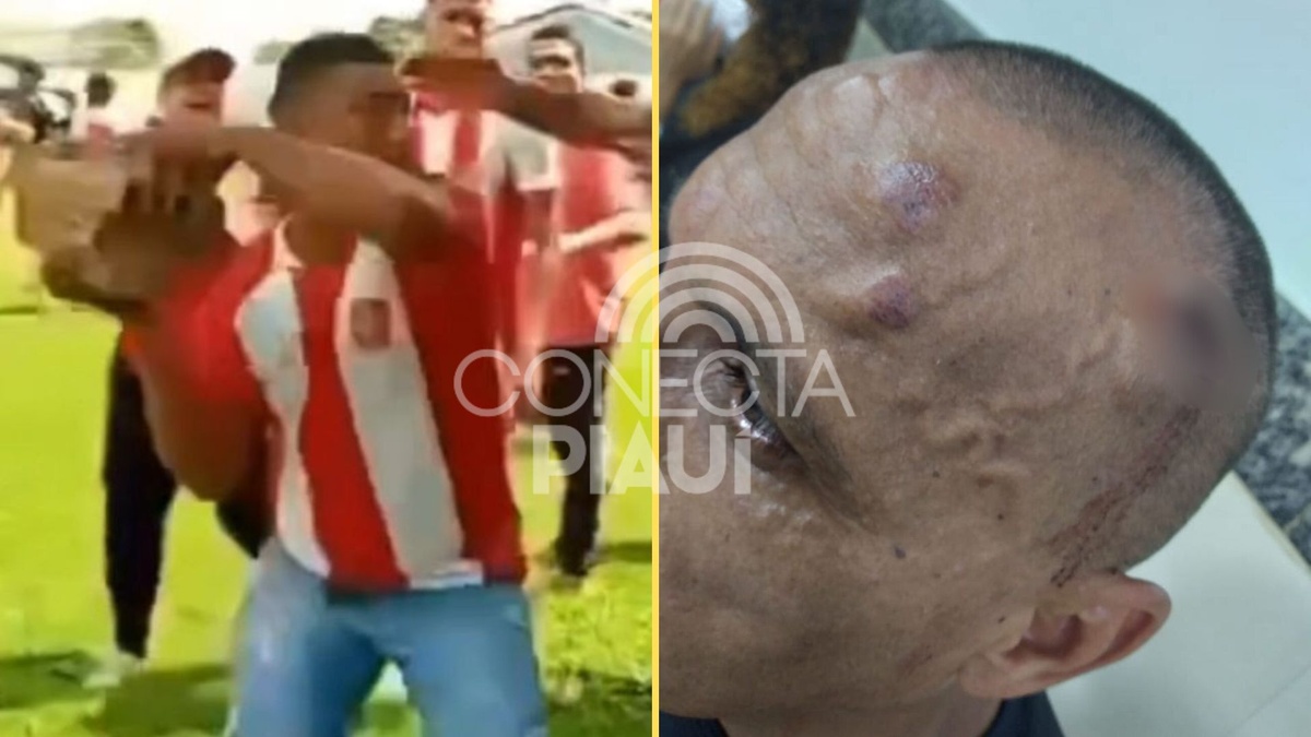 Árbitro é agredido com pedrada após cobrança de pênalti no Maranhão